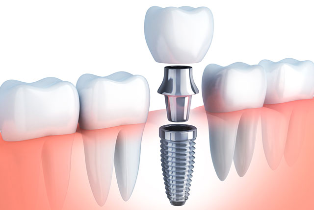 Implantes dentales: lo que tienes que saber.