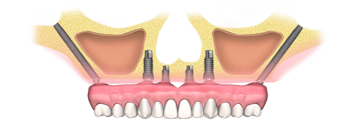 Implantes dentales cigomáticos