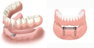 sobredentaduras-protesis-dentales-sobre-implantes-aguilar-dental-salut