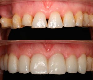 carillas dentales en Barcelona