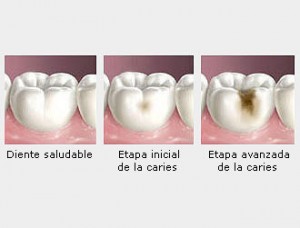 caries-dental-aguilar-dental-salut-barcelona