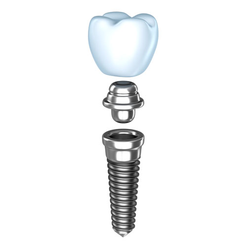 Implantes en un día Barcelona