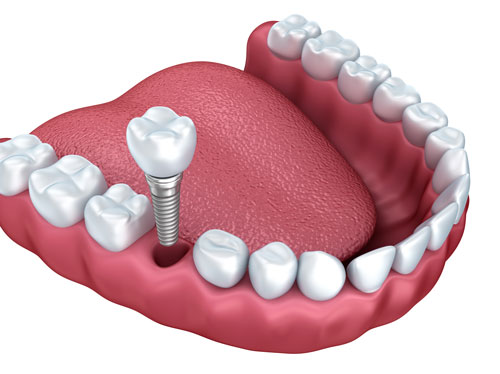 Implantes dentales unitarios