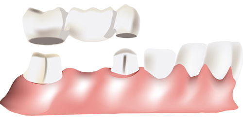 Prótesis dentales fijas