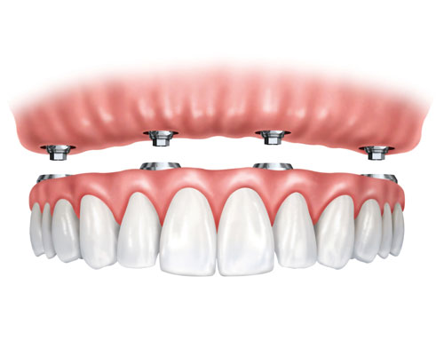 Prótesis híbrida sobre implantes dentales