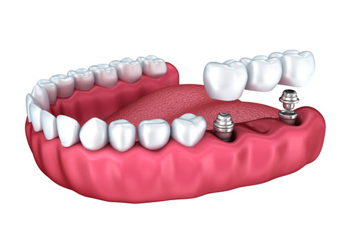 Prótesis dentales sobre implantes