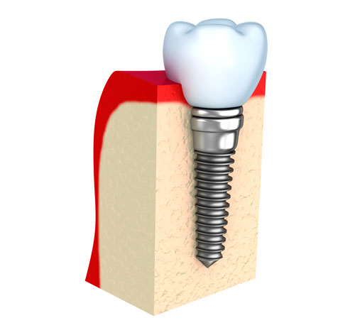 Implante dental de titanio