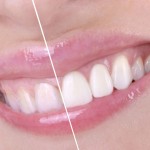 Una sonrisa más blanca con el blanqueamiento dental