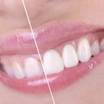 Una sonrisa más blanca con el blanqueamiento dental