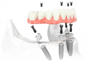 implante dental1