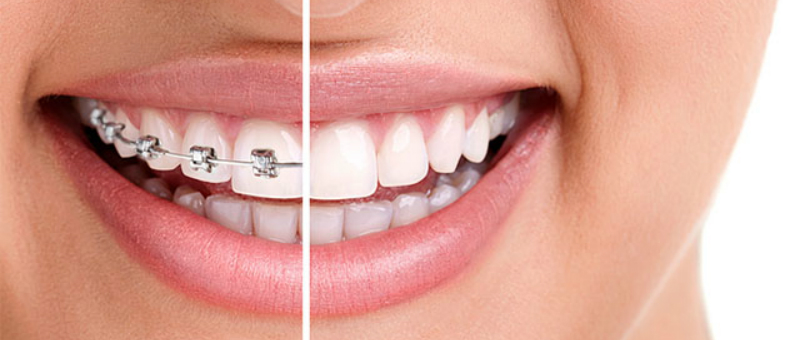 ¿Invisalign Teen o Brackets? Cómo saber cuál elegir