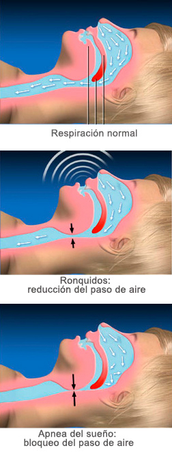 La Férula Anti Ronquidos y la Apnea del Sueño - Clínica Larrañaga