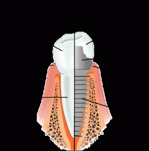 diagrama implante dental