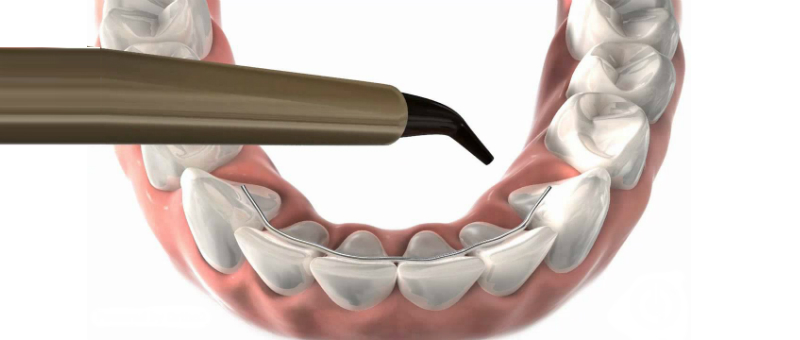 ¿Cómo evitar que los dientes se muevan después de la  Ortodoncia?