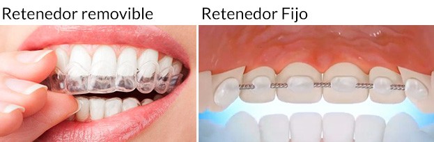El por qué de los elásticos durante el tratamiento de ortodoncia