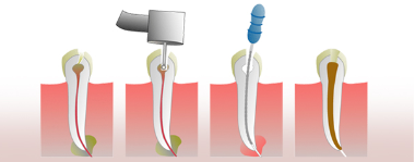 Postoperatorio de la endodoncia