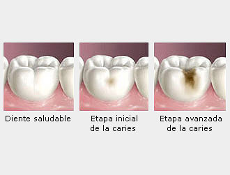 ¿Qué es la caries?