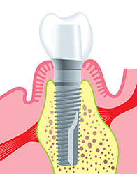 Colocación de la prótesis definitiva sobre los implantes dentales