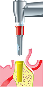 Cómo se colocan los implantes dentales