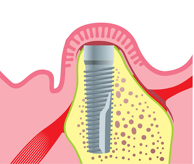 Osteointegración de los implantes dentales