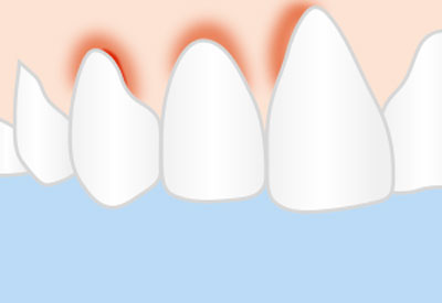 Gingivitis