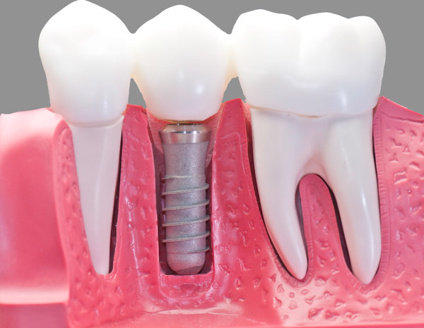 Prótesis dentales sobre implantes