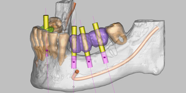 Implantes dentales con cirugía guiada