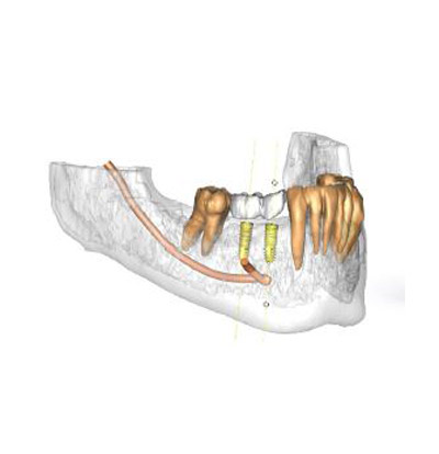 Implantes dentales con cirugía guiada
