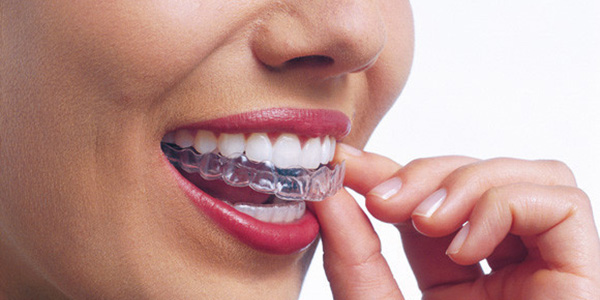 invisalign