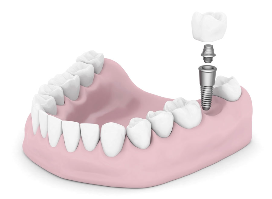 Marcas de implantes dentales