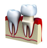 Prótesis dentales fijas