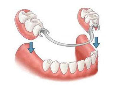 Prótesis dental removible