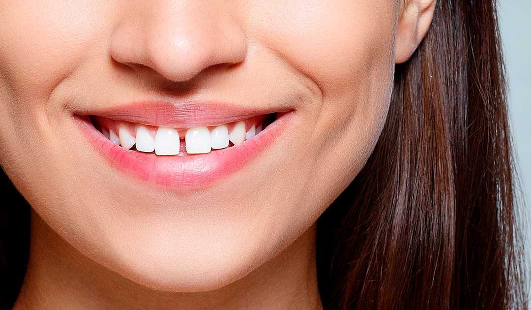 Diastema: ¿estética, salud o moda?