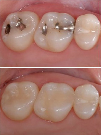 Prótesis dentales sobre implantes