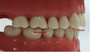 Dispositivo de avance mandibular en niños ▷ Ortodoncia Ourense