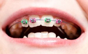 ortodoncia interceptiva en Barcelona