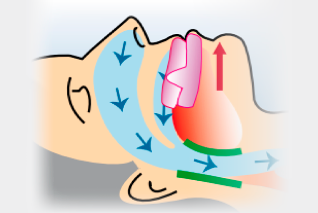 Anti Ronquidos y Apnea del Sueño - Clínica Dental VAS en Barcelona