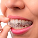 Invisalign boca Aguilar Dental