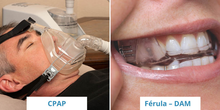 Apnea del Sueño, ventajas de la Férula-DAM vs CPAP Clinica Aguilar Dental  Salut en Barcelona