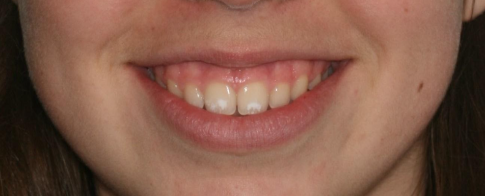 Manchas en los dientes: Por qué las tienes y cómo prevenirlas