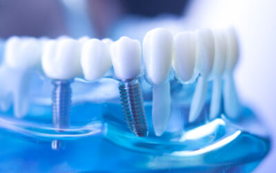 Cómo cuidar de tus implantes dentales