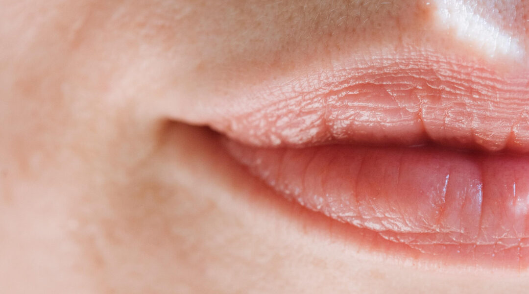 Un mucocele en el labio: ¿qué es y por qué lo tienes?