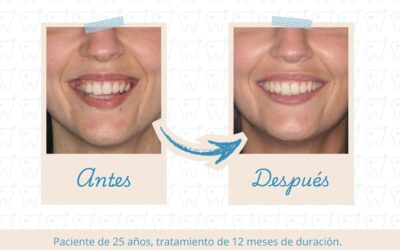 Ortodoncia Invisible en Barcelona | Aguilar Dental Salut