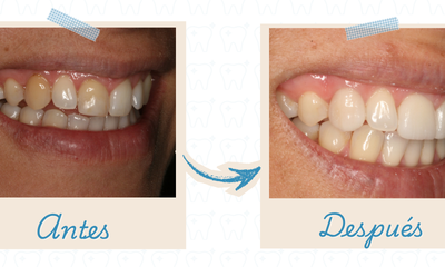 Carillas dentales con tecnología digital para diseñar sonrisas naturales
