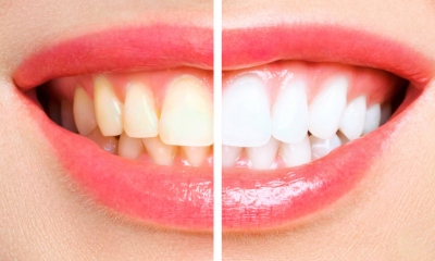 Blanqueamiento dental sin dañar el esmalte: guía para conseguir una sonrisa más blanca