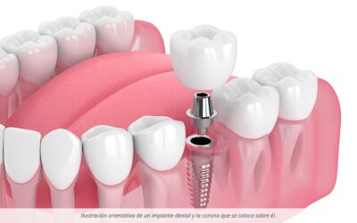 Implantes dentales paso a paso: todo el proceso desde la primera visita